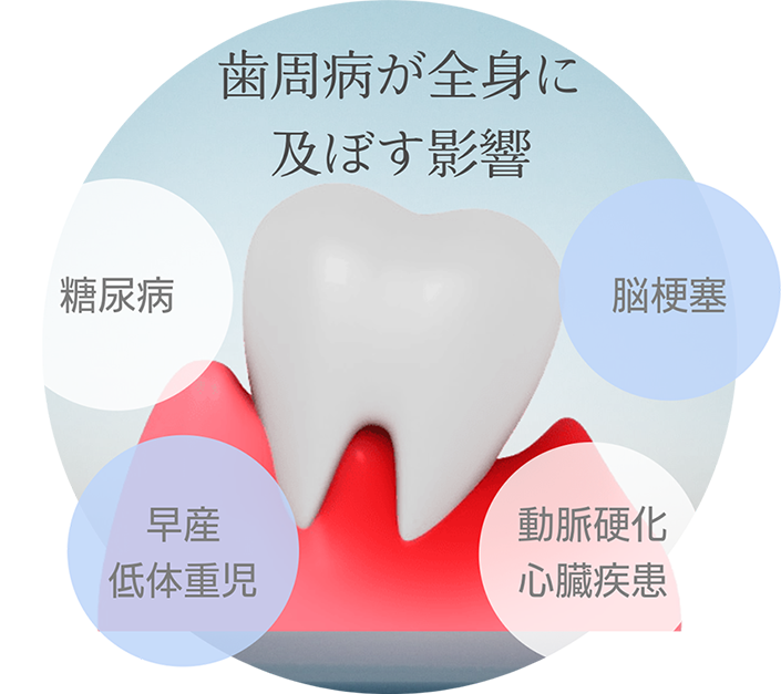 【歯周病が全身に及ぼす影響】糖尿病、早産・低体重児、動脈硬化・心臓疾患、脳梗塞