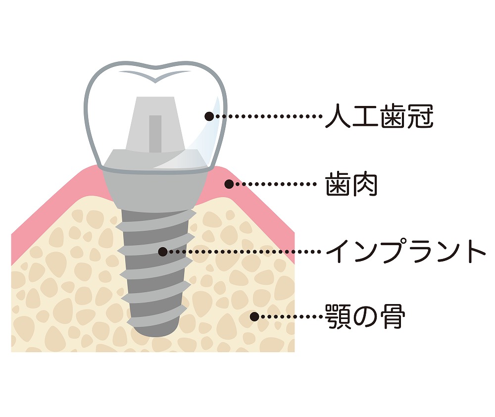 インプラントの構造