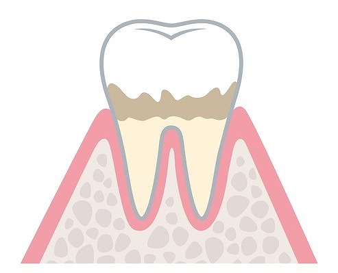 初期歯周病（歯肉炎）
