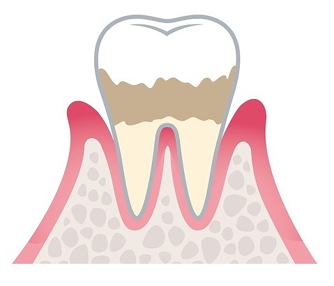 軽度歯周病