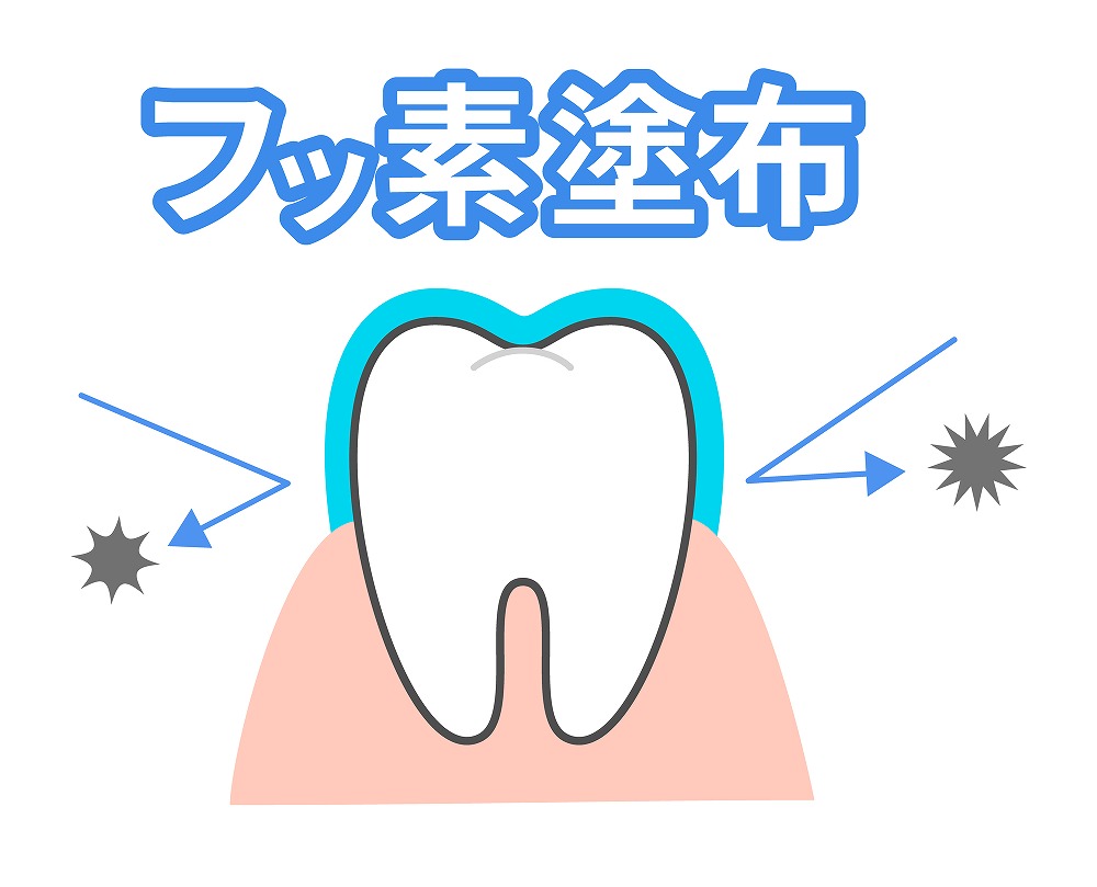 フッ素塗布